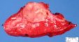 Bronchial carcinoid tumor