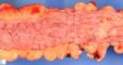 Colonic adenomatous polyposis