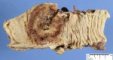 Colonic adenocarcinoma