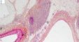 Renal hilum invasion