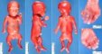 Short rib-polydactyly syndrome
