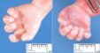 Fifth finger clinodactyly and palmar transverse crease in trisomy (...)