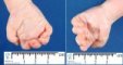Second, fourth and fifth finger clinodactyly in trisomy 21