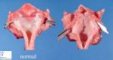 Laryngeal atresia