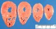 Normal myocardium