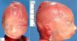 Oligohydramnios face (21 weeks)