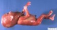 Cervical teratoma (21 weeks)