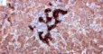 Cytokeratin-7 in ductular reaction