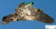 Pulmonary metastasis of an osteosarcoma