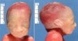 Oligohydramnios facies (23 weeks)