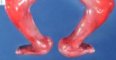 Rocker-bottom feet in fetal akinesia syndrome (21 weeks; case (...)