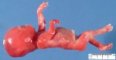 chondrodysplasia punctata