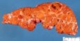 Macronodular cirrhosis and hepatocellualr carcinoma in tyrosinemia
