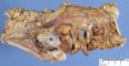 Colonic adenocarcinoma