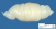 Neurofibroma