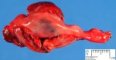 Ectopic tubal pregnancy