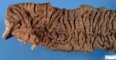 Colectomy of ulcerative colitis