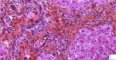Portal fibrosis and biliary ductular proliferation in juvenile (...)