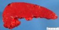 Splenic infiltration in Burkitt lymphoma