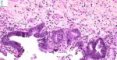 Biliary epithelial dysplasia in choledochal cyst