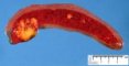 Hodgkin lymphoma invasion of the spleen