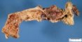 Crohn ileitis
