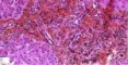 Portal fibrosis and biliary ductular proliferation in juvenile (...)