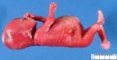 Megacystis with abdominal distension by urethral obstruction