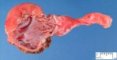 Pyelorenal duplication (Duplex kidney)