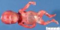 chondrodysplasia punctata