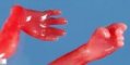 Omphalocele-radial ray aplasia complex (13w)