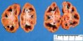 Congestion and hemorrhagic appearance of Malpighi pyramids in (...)