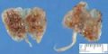 Bilateral non-obstructive multicystic renal dysplasia (BNOMRD)