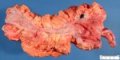 Crohn colitis