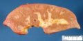 Cholestatic cirrhosis in extra-hepatic biliary tract atresia