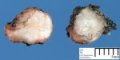 Intramuscular myofibroma