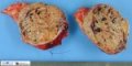 Pancreatic solid pseudopapillary tumor