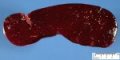 Splenomegaly in spherocytosis
