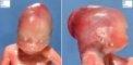 Micrognathia (Mandibular hypoplasia)
