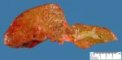 Dilatation of large bile ducts in extrahepatic biliary tract (...)