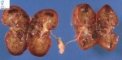 non-syndromal bilateral non-obstructive renal dysplasia