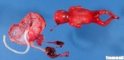 Exencephaly in an amniotic band syndrome