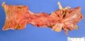 Crohn ileitis