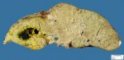 Cystic dilatation of a large bile duct in extrahepatic biliary tract (...)