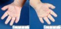 Clinodactyly and single transverse palmar crease in trisomy (...)