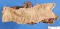 Colonic lymphangioma