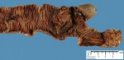 Intestinal invagination and perforative necrosis on Meckel diverticula