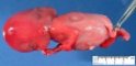 Left limb hypoplasia in a 18 weeks fetus
