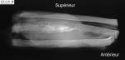Ewing sarcoma of the rib - radiology of the specimen