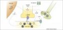 Alzheimer and synaptic scaling